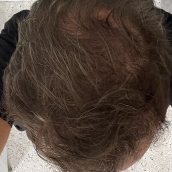 Cassia Cardoso - After 6 hair PRP treatments post-transplant - Skin Care Near Me - Ft Lauderdale, Florida Cassia Cardoso - After 6 hair PRP treatments post-transplant - Skin Care Near Me - Ft Lauderdale, Florida