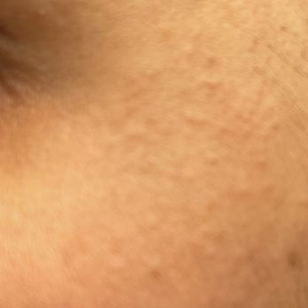 Flash Electrology - Thermal burns from using high heat. - Hair Removal Near Me - San Juan Capistrano, California Flash Electrology - Thermal burns from using high heat. - Hair Removal Near Me - San Juan Capistrano, California