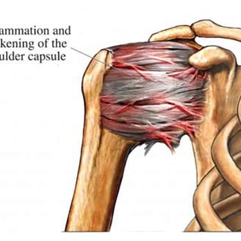 Derik Anderson, DC, CPT, CSN - Scar tissue and adhesions - Chiropractors Near Me - San Rafael, California Derik Anderson, DC, CPT, CSN - Scar tissue and adhesions - Chiropractors Near Me - San Rafael, California