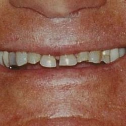 Alan Rosen DDS - Xpert Dental - BEFORE