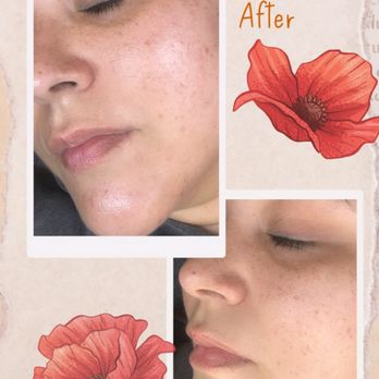 Classic Complexion - Microderm/Peel combo! - Waxing Near Me - Los Alamitos, California Classic Complexion - Microderm/Peel combo! - Waxing Near Me - Los Alamitos, California