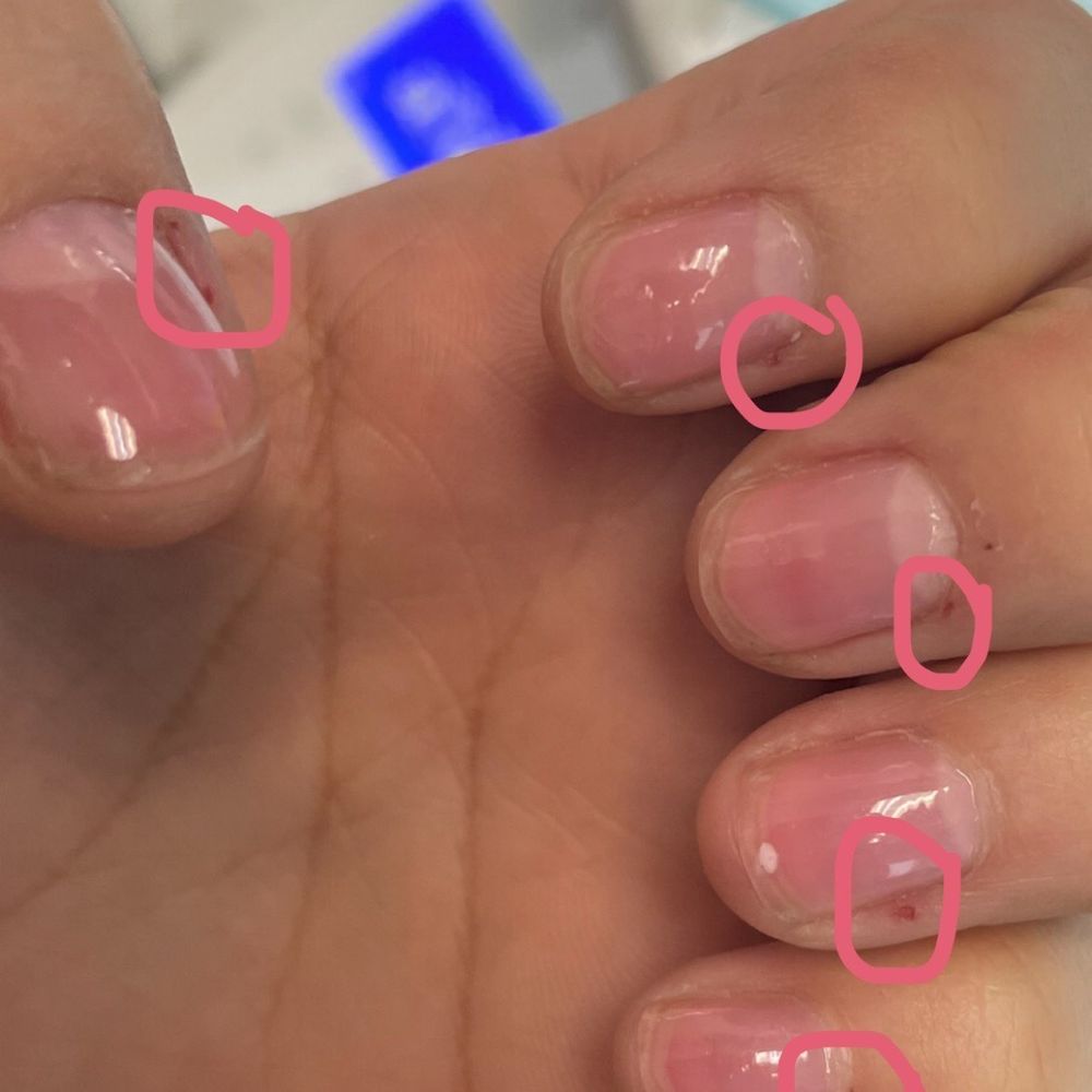 Was cut on all 10 finger during a manicure Was cut on all 10 finger during a manicure