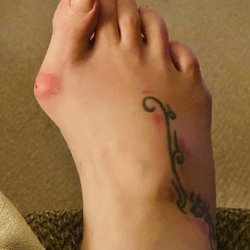 Clio Foot & Ankle - This is my right foot before the initial surgery.