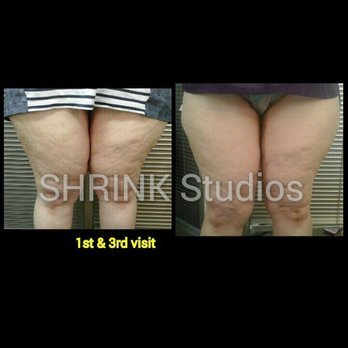 Shrink Studio & Spa - Thigh Buster Package "Non-Surgical Lipo & Anti Cellulite Vacuum" - Weight Loss Centers Near Me - Clarksville, Tennessee