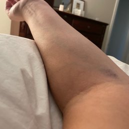 My bruise My bruise