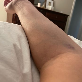 Sun Clinical Laboratories - My bruise - Laboratory Testing Near Me - Arcadia, California Sun Clinical Laboratories - My bruise - Laboratory Testing Near Me - Arcadia, California