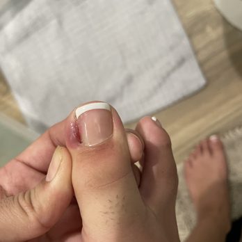 Creative Nails & Spa - Swollen toe! - Nail Salons Near Me - West Covina, California Creative Nails & Spa - Swollen toe! - Nail Salons Near Me - West Covina, California
