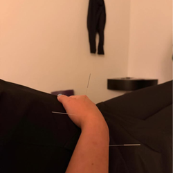 Accupuncture