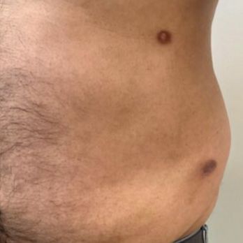 MyShape Lipo - Scars, lumpy, uneven liposuction. - Medical Spas Near Me - Henderson, Nevada