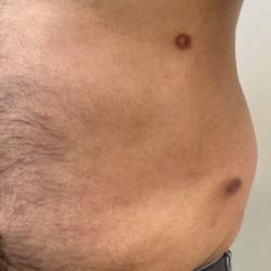 MyShape Lipo - Scars, lumpy, uneven liposuction.