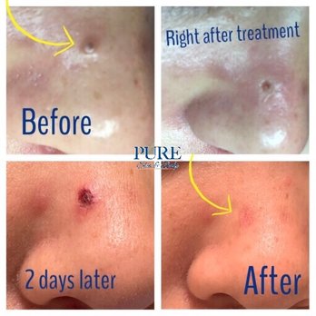 Pure Skin OC - ThermoClear - Skin Care Near Me - Villa Park, California Pure Skin OC - ThermoClear - Skin Care Near Me - Villa Park, California