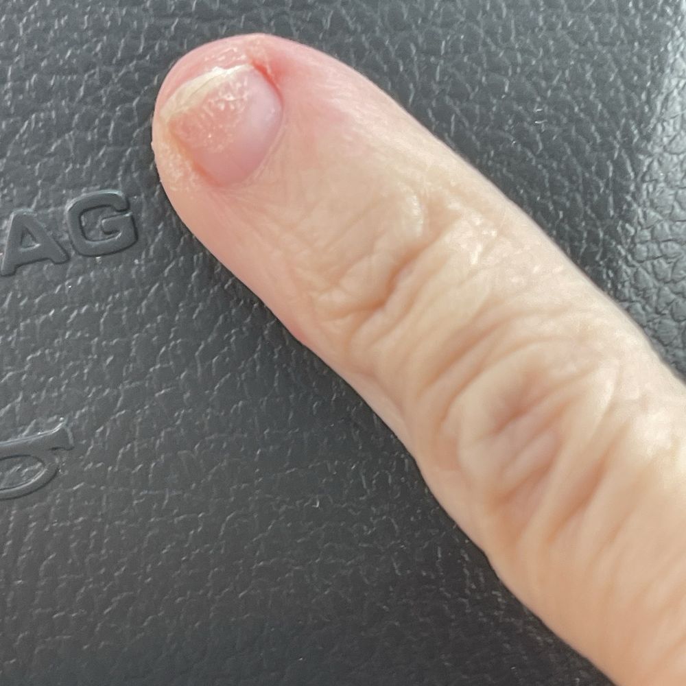 Peache Nails and Spa - Severe painful nail damage, - Nail Salons Near Me - Marietta, Georgia Peache Nails and Spa - Severe painful nail damage, - Nail Salons Near Me - Marietta, Georgia