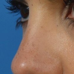 Aaron Kosins, MD - An exceptional rhinoplasty looks elegant from every angle even when looking with the finest detail