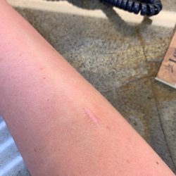 Dermatology Associates - How a scar should look