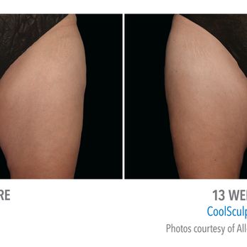 Aloha Nani Kino Spa - Coolsculpting on thighs - Medical Spas Near Me Aloha Nani Kino Spa - Coolsculpting on thighs - Medical Spas Near Me
