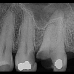 Birdseye Dentistry - Comparison:  Premolar 12 (left) root Premolar 13 (center) root Molar 14 (right) roots