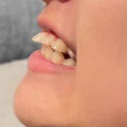 Western Dental & Orthodontics Kids - The outcome after two years of brace