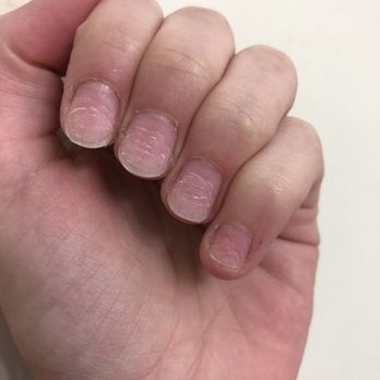 Pavilion Nail Lounge - These nails were pried off and you can clearly see the damage from the keratin layers being ripped off. This is NOT proper nail removal - Nail Salons Near Me - Woodstock, Georgia Pavilion Nail Lounge - These nails were pried off and you can clearly see the damage from the keratin layers being ripped off. This is NOT proper nail removal - Nail Salons Near Me - Woodstock, Georgia