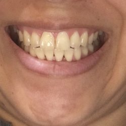 Truly Yours Family Dental - Before the bleaching and filling. You can see where my enamel is worn down on the front left tooth.