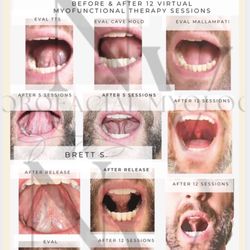 NV Orofacial Myology - Adult male, post jaw surgery, lessened headaches, snoring and pain