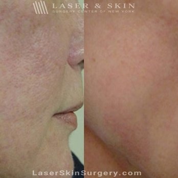 Laser & Skin - Laser Treatment for Broken or Enlarged Blood Vessels on the Cheek - Dermatologists Near Me - Devon, Pennsylvania