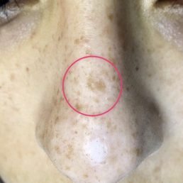 BEFORE freckle/ sun spot removal BEFORE freckle/ sun spot removal