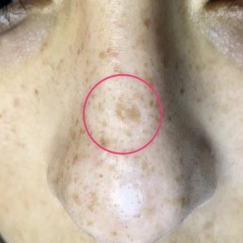 Studio Juno - BEFORE freckle/ sun spot removal - Permanent Makeup Near Me - Orange, California Studio Juno - BEFORE freckle/ sun spot removal - Permanent Makeup Near Me - Orange, California