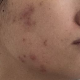 March/April 2020 when I first started to get painful acne
