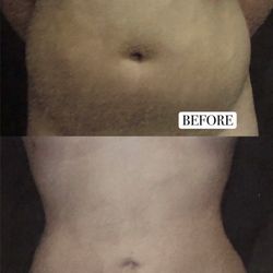Parvin Mirabadi, MD - Liposuction of abdomen (**Procedure performed by Dr. Mirabadi. Individual results may vary.**)