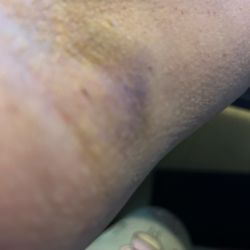 Labcorp - Black and blue one week after blood work and my arm hurt for three days.