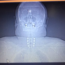 Neurosurgical Associates of San Antonio - Metal around neck