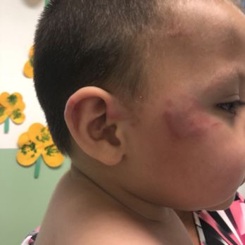 Young Achiever's Learning Center - This happen in this daycare more then 10 bites - Child Care & Day Care Near Me - Franklin Park, Illinois Young Achiever's Learning Center - This happen in this daycare more then 10 bites - Child Care & Day Care Near Me - Franklin Park, Illinois
