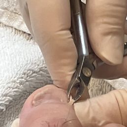 Hangnail Hangnail