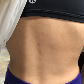 Kalahari - bed bug bites from there dirty beds - Resorts Near Me - Sandusky, Ohio Kalahari - bed bug bites from there dirty beds - Resorts Near Me - Sandusky, Ohio