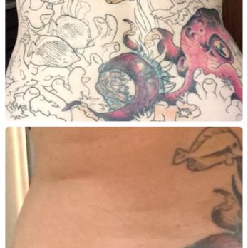Clean Canvas Laser - Tattoo Removal Near Me - Houston, Texas Clean Canvas Laser - Tattoo Removal Near Me - Houston, Texas
