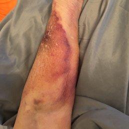 One of multiple bruises. One of multiple bruises.