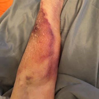 Glencroft Center for Modern Aging - One of multiple bruises. - Retirement Homes Near Me - Glendale, Arizona Glencroft Center for Modern Aging - One of multiple bruises. - Retirement Homes Near Me - Glendale, Arizona