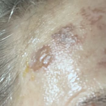 First State Med Spa - Blisters on forehead - Medical Spas Near Me - Wilmington, Delaware
