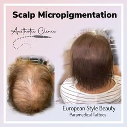 European Style Beauty Spa - Hair density
scalp micropigmentation