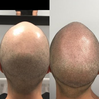 3DScalpWorks - Before & After (Right After Procedure) - Hair Loss Centers Near Me - Glendale, California 3DScalpWorks - Before & After (Right After Procedure) - Hair Loss Centers Near Me - Glendale, California