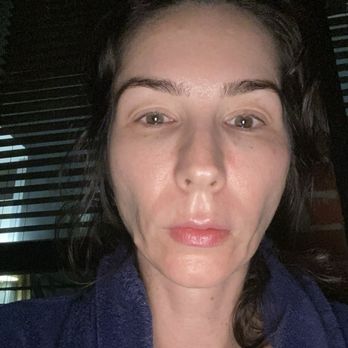 The Retreat Restorative & Aesthetic - My face within a week of hyaluronidase injection. Aka hylnex - Medical Spas Near Me - Rockwall, Texas