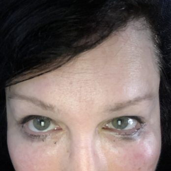 James Scheu, MD, FACS - Different size eyes - Plastic Surgeons Near Me - St. Louis, Missouri