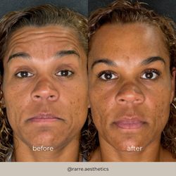 Rarre Aesthetics & Wellness - Patient results after her first-time tox (wrinkles relaxer) treatment!