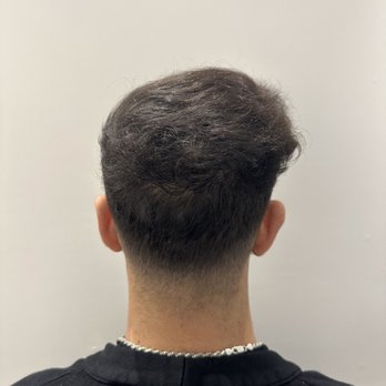 Barber Surgeons Guild - 1 year after back - Hair Loss Centers Near Me - West Hollywood, California