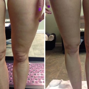 Wrap U Skinny - Actual client after one full body wrap - Weight Loss Centers Near Me - Fenton, Missouri Wrap U Skinny - Actual client after one full body wrap - Weight Loss Centers Near Me - Fenton, Missouri