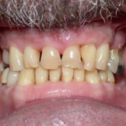 Full Mouth Rebuild Before