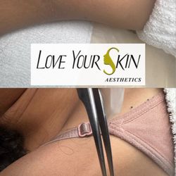 Love Your Skin Aesthetics - Skin tag