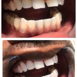 Teeth Jewel - Before and after 60 min laser teeth whitening at Flossy.