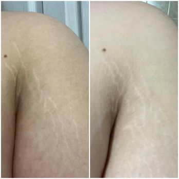 Magsnificent Skin - Wow! Amazing results with just one session - Skin Care Near Me - Upland, California Magsnificent Skin - Wow! Amazing results with just one session - Skin Care Near Me - Upland, California