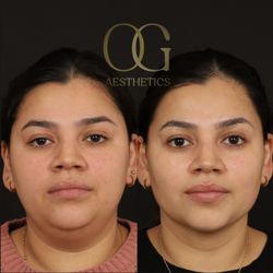 OG Aesthetics - 32 yo F 3 months after submental liposuction and RF Microneedling